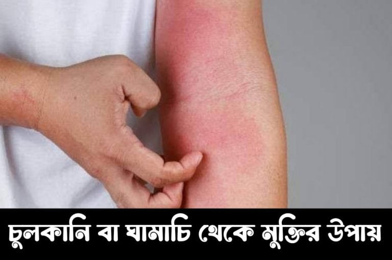 এলার্জি,চুলকানি,ঘামাচি ও দুর্গন্ধ থেকে মুক্তির উপায়।